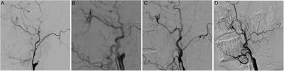 Hybrid surgery versus endovascular intervention for patients with chronic internal carotid artery occlusion: A single-center retrospective study